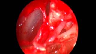 Transcanal endoscopic assisted exploration of the ossicular chain [upl. by Roselba614]