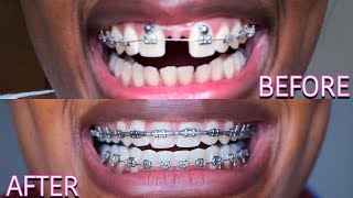 3 MONTH BRACES UPDATE  Damon Braces OverjetOverbite  Adult Braces [upl. by Cilurzo]