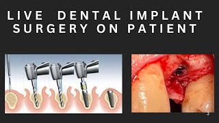 DENTAL IMPLANT SURGERY LIVE ON PATIENT WITH EACH STEP OdontologyInnbyDrMuhammadAhmad [upl. by Phipps]