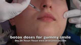 botox doses for gummy smile [upl. by Monjan714]