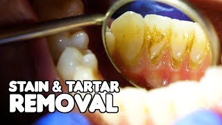 Dental Cleaning EXPLAINED  Stain amp Tartar Removal [upl. by Dacia780]