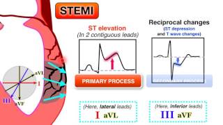 Ischemia 67  STEMI on ECG [upl. by End]