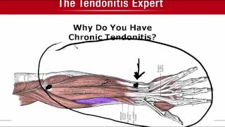 Why Do You Have Chronic Tendonitis [upl. by Oirretna983]