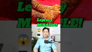 Leprosy Healing MIRACLE 😱 prayer supernatural [upl. by Delano]