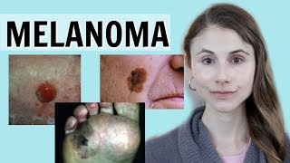 Melanoma skin cancer QampA with dermatologist Dr Dray [upl. by Moira385]