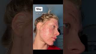 One year of acne scar progress in under 7 seconds acne skincare [upl. by Wilone]