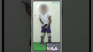 child with cerebral palsy started walking with activityoriented therapy at Trishla shorts [upl. by Auod]