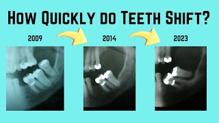 How Quickly do Teeth Shift [upl. by Albina]