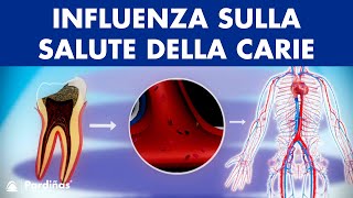 Carie denti e la sua influenza sulla salute © [upl. by Sacrod]