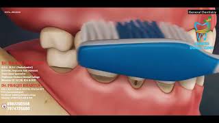 Protecting Your Pearly Whites Understanding Tooth Abrasion [upl. by Corrinne]