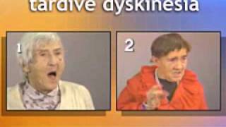 Tardive Dyskinesia videoavi [upl. by Rufe376]