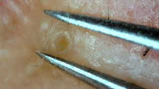 0289 keratin plug removal chin [upl. by Ioves111]