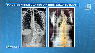 Il Mio Medico Tv2000  La fisioterapia per curare la scoliosi [upl. by Pavlov]