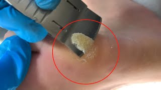 Callus removal from feetampFoot scraping dead skin【Xiao Yan pedicure】stress 914 [upl. by Savdeep]