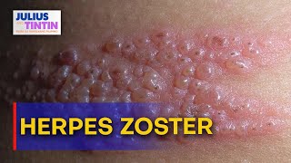 Ano ang herpes zoster  JNT [upl. by Oona]