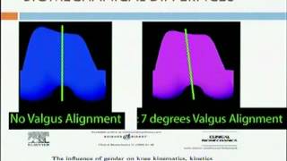 Biomechanics of Knee and its implication in Total Knee Arthroplasty [upl. by Ellehcem]