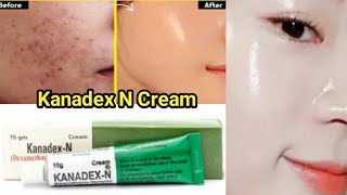 Kanadex N Cream Review  Freckles Removal Treatment  Kanadex n cream purpose  Use  Side effects [upl. by Eiwoh]