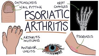 Psoriatic Arthritis [upl. by Eulalie281]