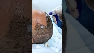 Headwash After Hair Transplant at Cara Clinic [upl. by Tabbitha]