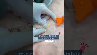 Tratamento com escleroterapia [upl. by Gnilsia]