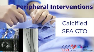 CCC Live Cases  Peripheral Interventions  Calcific SFA CTO  January 24 2024 [upl. by Birdt]