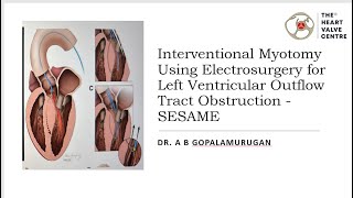 Interventional Myotomy Using Electrosurgery for Left Ventricular Outflow Tract Obstruction  SESAME [upl. by Eanahs]