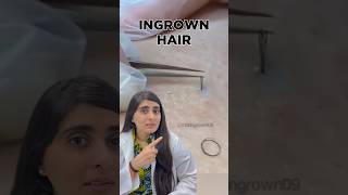 Ingrown Hair Removal  Ingrown Hair Treatment  Ingrown Hair Dermatologist [upl. by Jarrod]