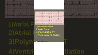 ECG diagnosis  ECG Analysis  ecg reading ecg ecginterpretation ventriculartachycardia vf svt [upl. by Okiam]