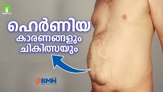 ഹെർണിയ വരാനുള്ള പ്രധാന കാരണം  Hernia Malayalam Health Tips [upl. by Buine]