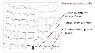 ECG BASICS I PREMATURE VENTRICULAR COMPLEX PVC I BIGEMINY [upl. by Simona]