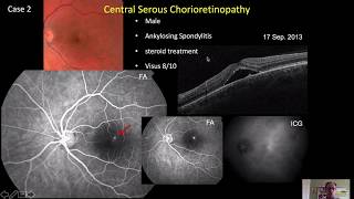 Clinical Case on Central Serous Chorioretinopathy  Massimo Nicolò [upl. by Sedrul89]