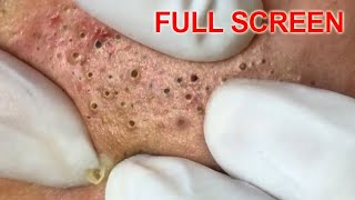 Blackheads removal  Best Pimple Popping Videos [upl. by Grim]