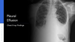 Pleural Effusion Explanation of Xray Findings [upl. by Acinok]