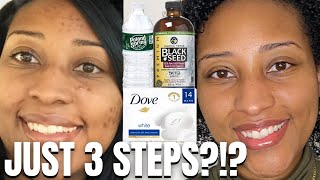 FADE Hyperpigmentation in Black Skin in 3 EASY Steps [upl. by Sadie]