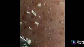 cabut komedo  acne treatment sound asmr [upl. by Ayihsa]