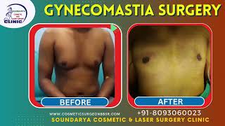 Gynecomastia Patient feedback video Dr Laxmikanta mishraCall 8093060023 [upl. by West]