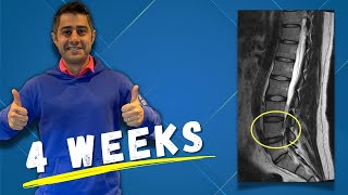 L4 L5 L5 S1 disc herniation recovery within 4 weeks [upl. by Hilton575]