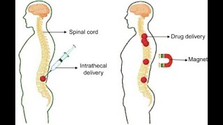 Intrathecal Route of Drug Administration  Uses Procedure Advantages Disadvantages [upl. by Dihsar40]