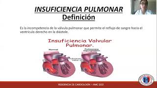 Semiología Cardiovascular Valvulopatía pulmonar [upl. by Gemperle111]