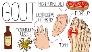 Understanding Gout Gout Explained Clearly [upl. by Thirion]