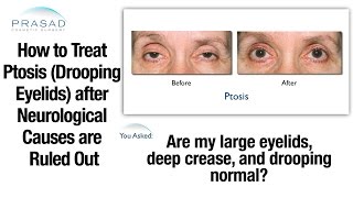 Rule Out Neurological Causes of Drooping Eyelids before Ptosis Correction Surgery [upl. by Iline]