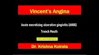 Vincents angina Acute Necrotizing Ulcerative Gingivitis ANUGTrench Mouth Slide Explanation [upl. by Lipson]