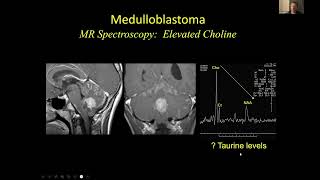 Neuroradiology of Medulloblastomas  Dr Suresh Mukherji MD MBA FACR amp Dr Hemant Parmar MB BS [upl. by Llenwahs]