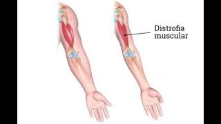 Distrofia muscular de Duchenne Podcast [upl. by Ytsirhc757]