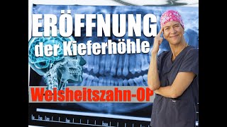 WEISHEITSZAHNOP KIEFERHÖHLE eröffnet WAS bedeutet dasRICHTIGES Verhalten danach [upl. by Ecirtnahs415]