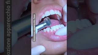 Rimozione apparecchio fisso dai denti  rimozione dei brackets ortodontici [upl. by Tichonn685]