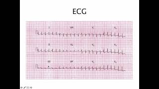 48 EKG case study pulmonary embolism  ករណីសិក្សារECGលើអ្នកជំងឺមានស្ទះសសៃឈាមសួត [upl. by Gresham]