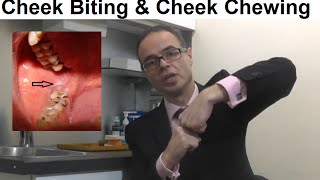 Problems Associated With Cheek Biting Cheek Chewing or Morsicatio Buccarum by Dr Mike Mew [upl. by Annej]