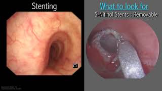 Mastering Bronchoscopy for Thoracic Surgery Chapter 3 [upl. by Earas]