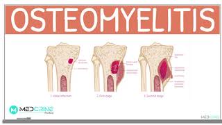 Osteomyelitis Classification Causes Pathophysiology Signs and Symptoms Diagnosis and Treatment [upl. by Ynnot444]